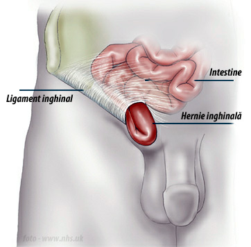 Prostatită și hernie