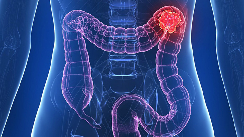 cancer de colon drept simptome