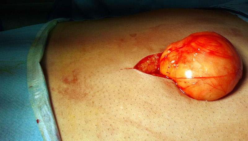 Operatie clasica de hernie epigastrica (sacul de hernie)
