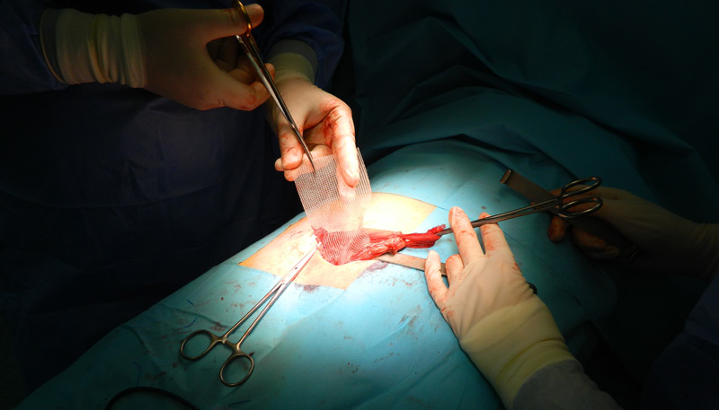 Operatia Lichtenstein (repararea herniei inghinale cu plasa, prin abord clasic): croirea plasei
