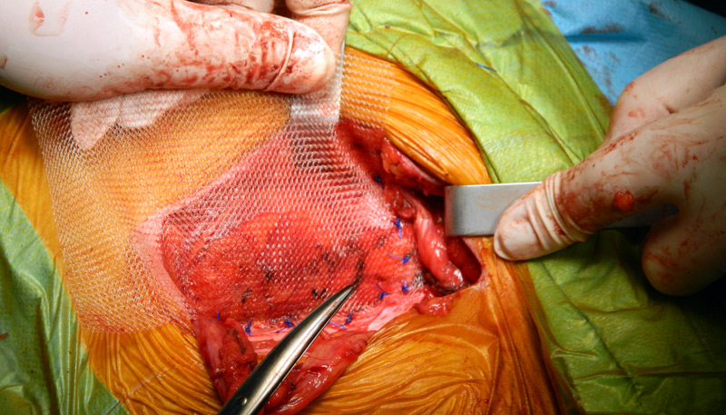 Repararea unei hernii inghinale prin abord clasic, cu plasa de polipropilena