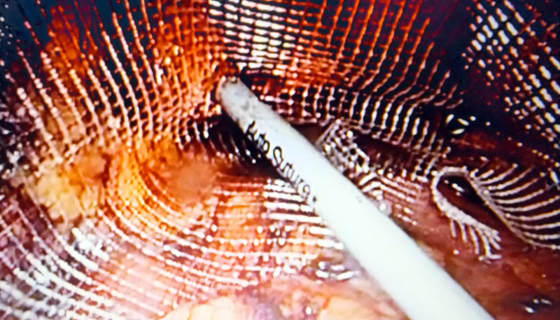 Operatie laparoscopica de hernie inghinala cu plasa de polipropilena light (cu ochiuri rare)