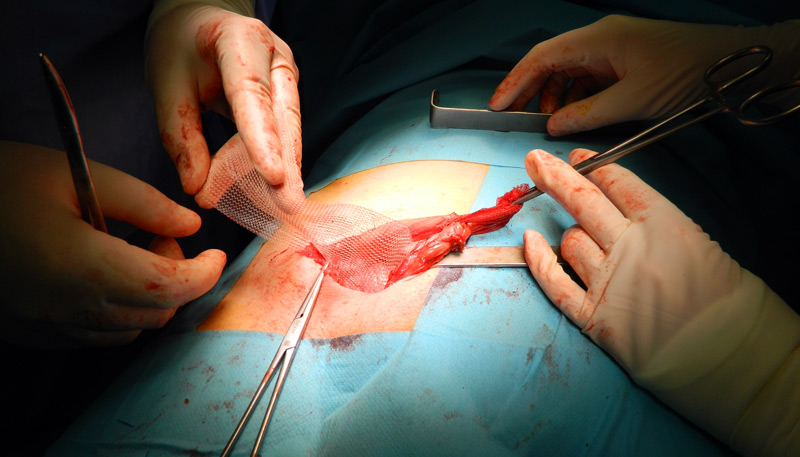 Operatia Lichtenstein (repararea herniei inghinale cu plasa, prin abord clasic): pozitionarea plasei in jurul cordonului spermatic