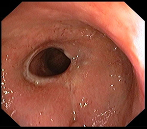 Cancer de rect superior operat (anastomoza mecanica); aspect colonoscopic la 3 luni de la operatie.