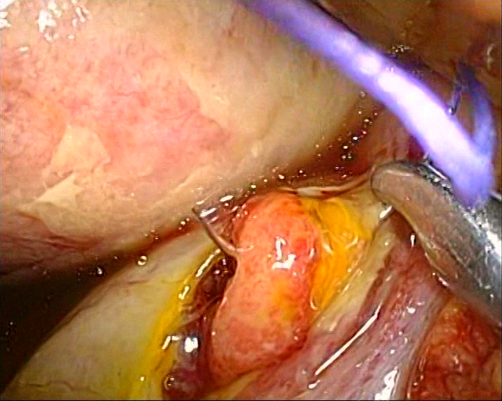 Sutura laparoscopica a ulcerului bulbar perforat