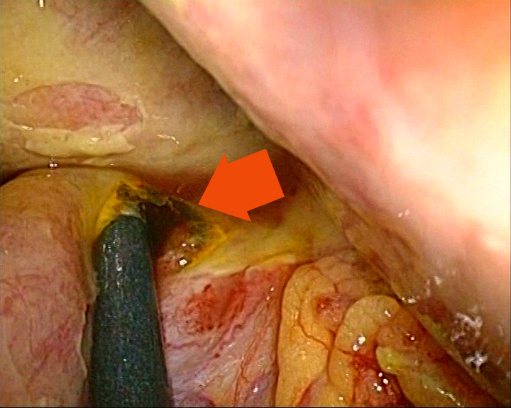Ulcerbulbar-(duodenal)-perforat